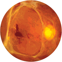 Retinopatia Diabética