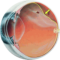 Descolamento de Retina
