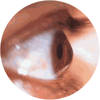 Ceratocone
