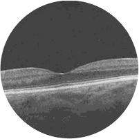 OCT de Retina